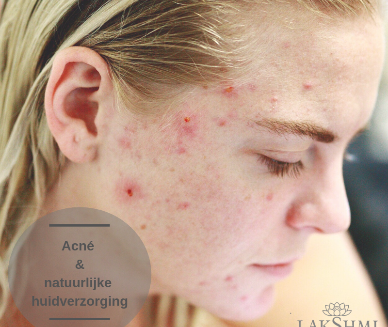 Kapha huid – Acne – Onzuivere huid